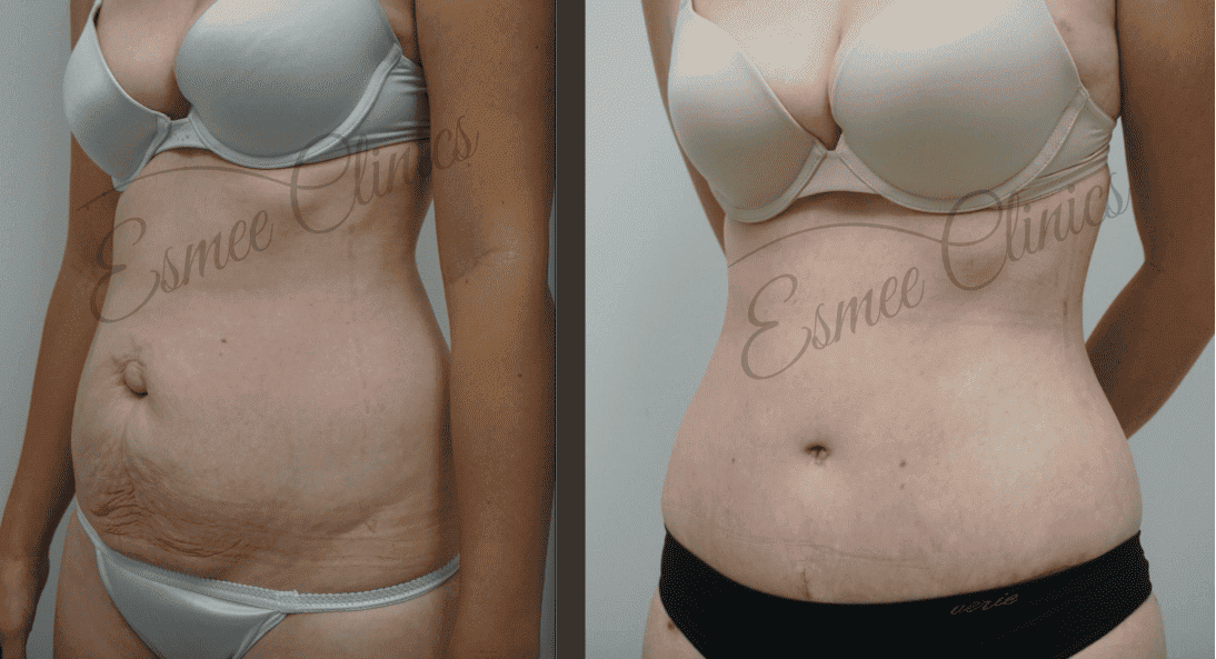 Before and After img